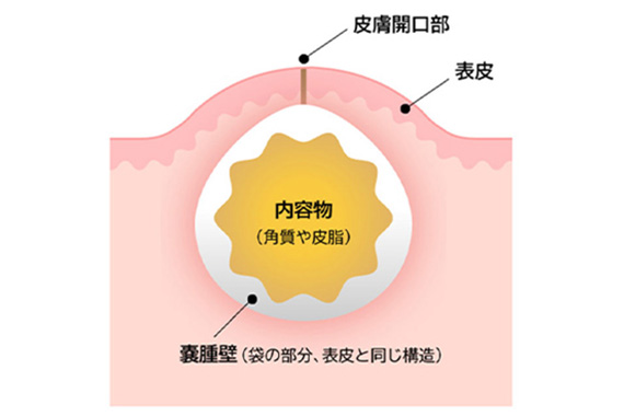粉瘤ができる原因写真